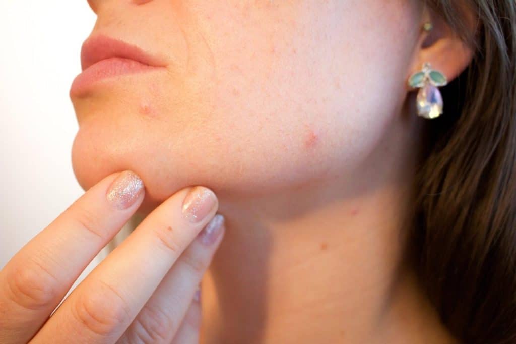 acne, pores, skin, pimple, female, face, skincare, infection, treatment, disease, dermatology, facial, person, hygiene, painful, scar, irritation, young, bacteria, pus, caucasian, eruption, sebaceous, blackhead, complexion, hormone, girl, woman, lady, party killer, crisis, emergency, blemish, problems, cheek, sore, cosmetic, adult, spots, products, health, care, problematic, killjoy, inconvenient, timing, party, hacks, chick, epidermis, help, zit, bothersome, annoying, outbreak, makeup, non-comedogenic, foundation, color, tone, undertone, medical, puberty, acne, acne, acne, acne, acne, pimple